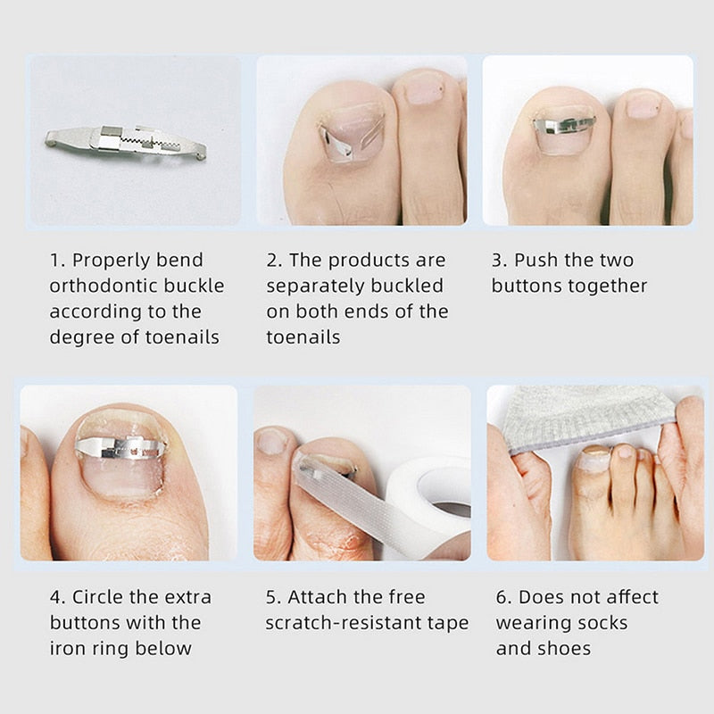 Ingrown Toenail Corrector Tools Pedicure Recover Embed Toe Nail Treatment